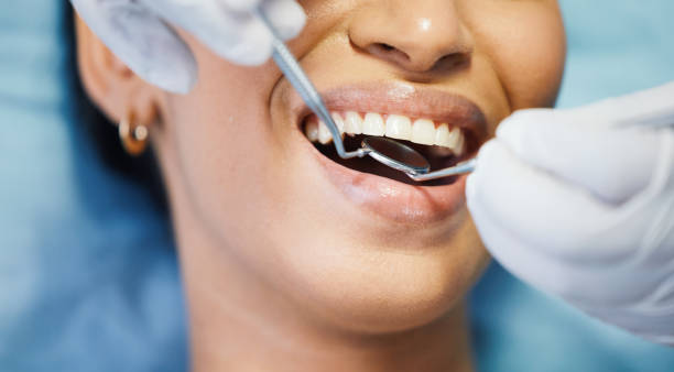 Best Knocked-Out Tooth (Avulsed Tooth) Treatment in Snow Hill, NC